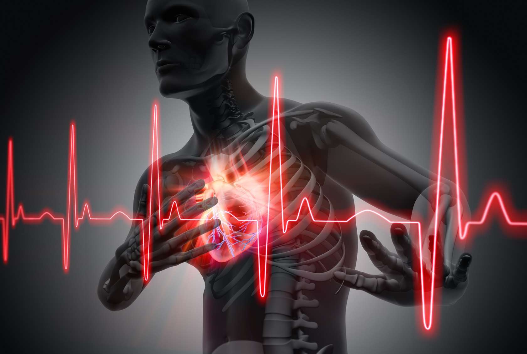 Infarctus Du Myocarde